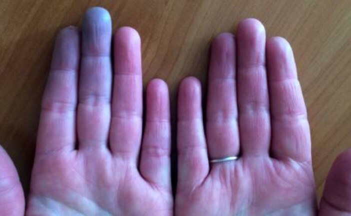 Доктор, у меня пальцы синие: как распознать болезнь Рейно
