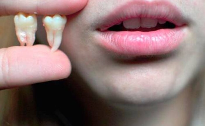 Стоматологи объяснили пользу зубов мудрости