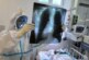 Легкие поражены, кислород в норме: врач объяснил парадокс коронавируса