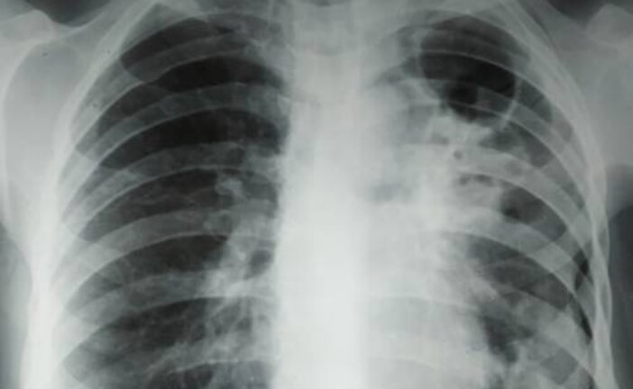 Россия вошла в мировую тройку стран по количеству случаев туберкулеза