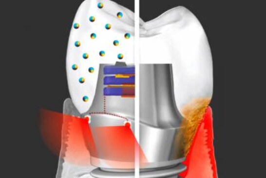 Новый зубной имплантат может лечить десны