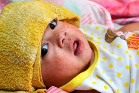 Из-за пандемии 22 миллиона детей во всем мире не получили прививки от кори